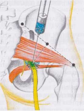 Блокада седалищного нерва по Муру Блокада седалищного нерва по Муру